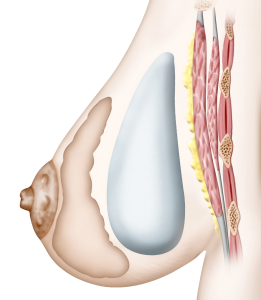 protheses pré-musculaire 